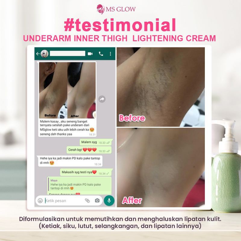Although multisystem inflammatory syndrome (mis) is described in children. Jual Underarm Ms Glow Pemutih Ketiak Pemutih Area Mis V Pemutih Lutit Pemutih Lekukan Hitam Indonesia Shopee Indonesia