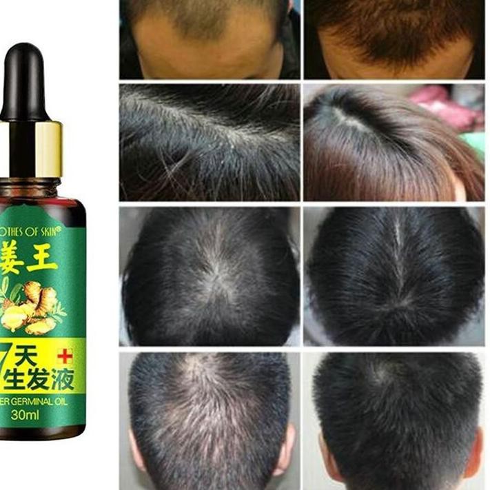Tturiya · d · 0.175myr, 6.06% ; Jual Produk Baru Ready Stock 7 Days Hair Care Hair Growth Essential Oil Ginger Germinal Oil Pei Indonesia Shopee Indonesia