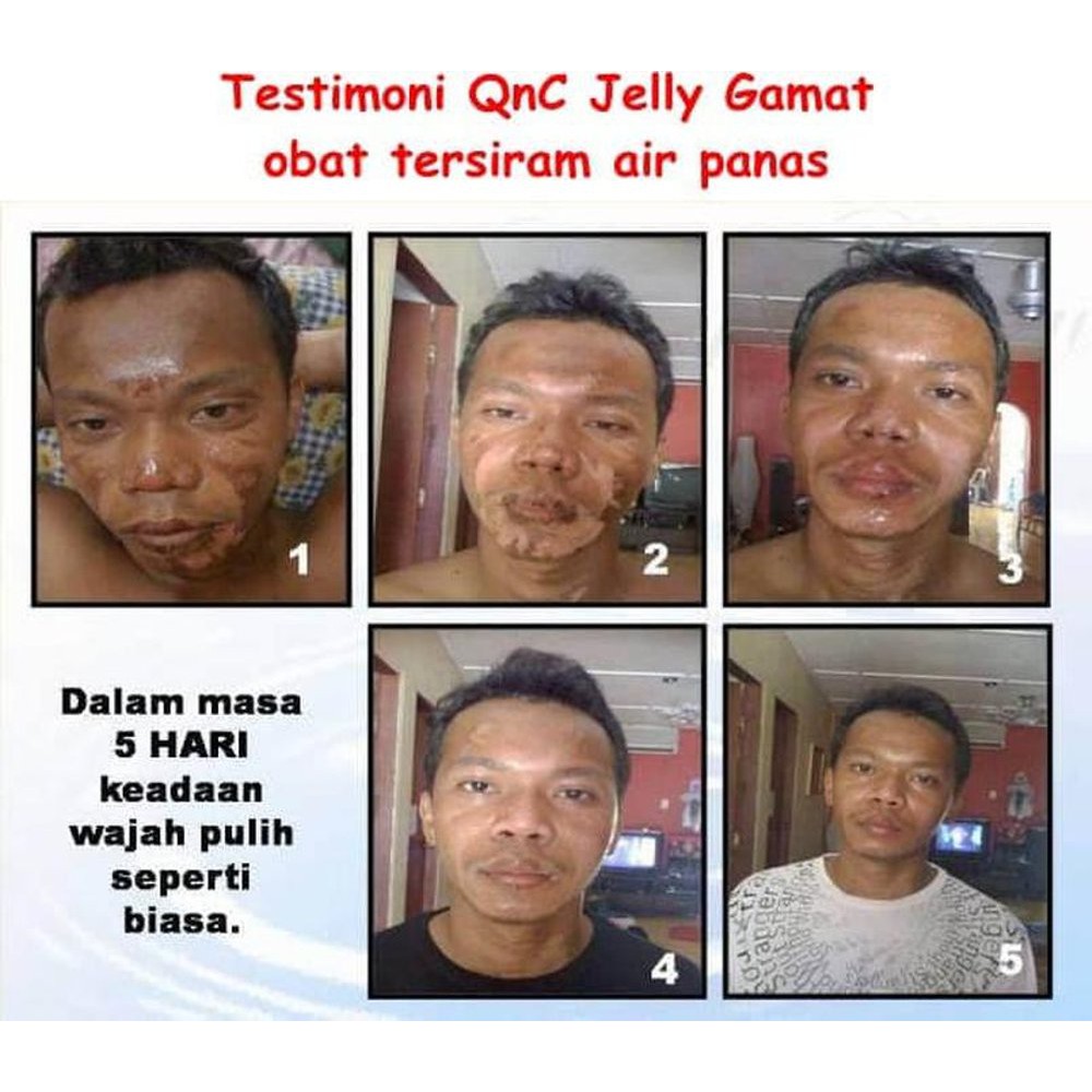 Obat Luka Tersiram Air Panas Luka Tersiram Air Panas Obat Oles