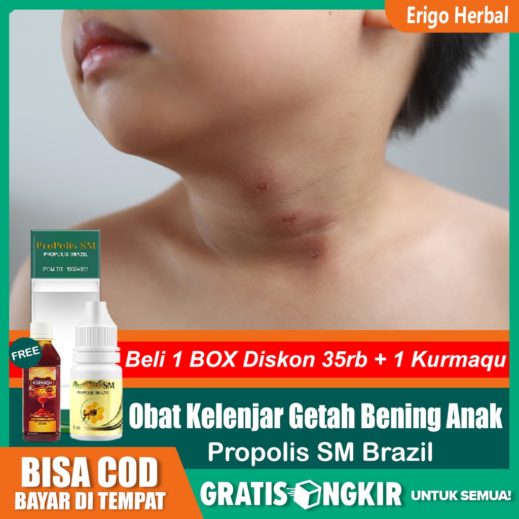 Campuran baking soda dengan garam laut ini . Jual Obat Kelenjar Getah Bening Anak Gondok Benjolan Di Leher Pada Anak Herbal Propolis Sm Tangerang Indonesia Shopee Indonesia