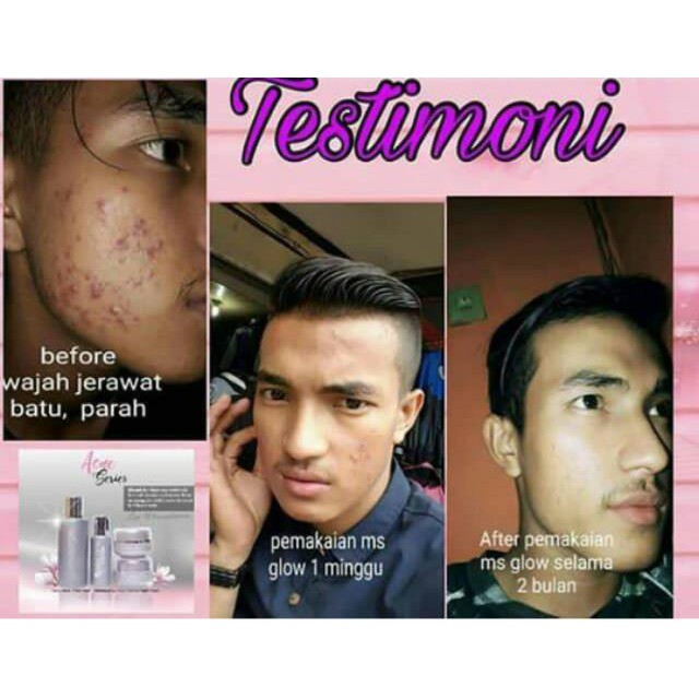 Gunakan bahan alami kulit jeruk dan cuka apel untuk menghilangkan jerawat. Jual Ms Glow Paket Acne Menghilangkan Jerawat Batu Membandel Free Tote Bag Indonesia Shopee Indonesia