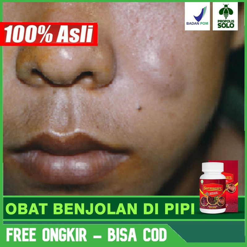 1.onset gejala akut (beberapa menit hingga beberapa jam) yang melibatkankulit, jaringan mukosa, atau keduanya (misal: Jual Obat Benjolan Di Pipi Pipi Bengkak Sakit Gigi Gusi Herbal Sarmucare Di Jakarta Pusat Bisa Cod Indonesia Shopee Indonesia