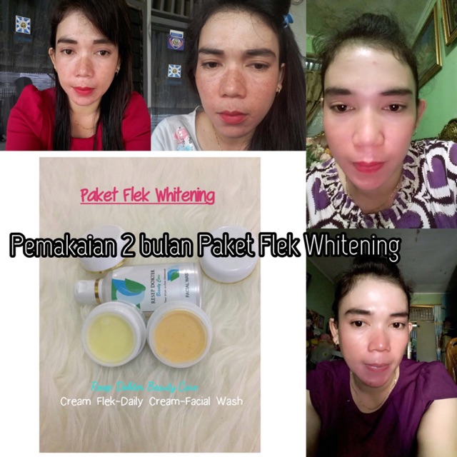 Tidak instan ya, sebab pemeliharaan kulit yang benar adalah berproses. Testimoni Pemakaian Paket Flek Whitening Shopee Indonesia