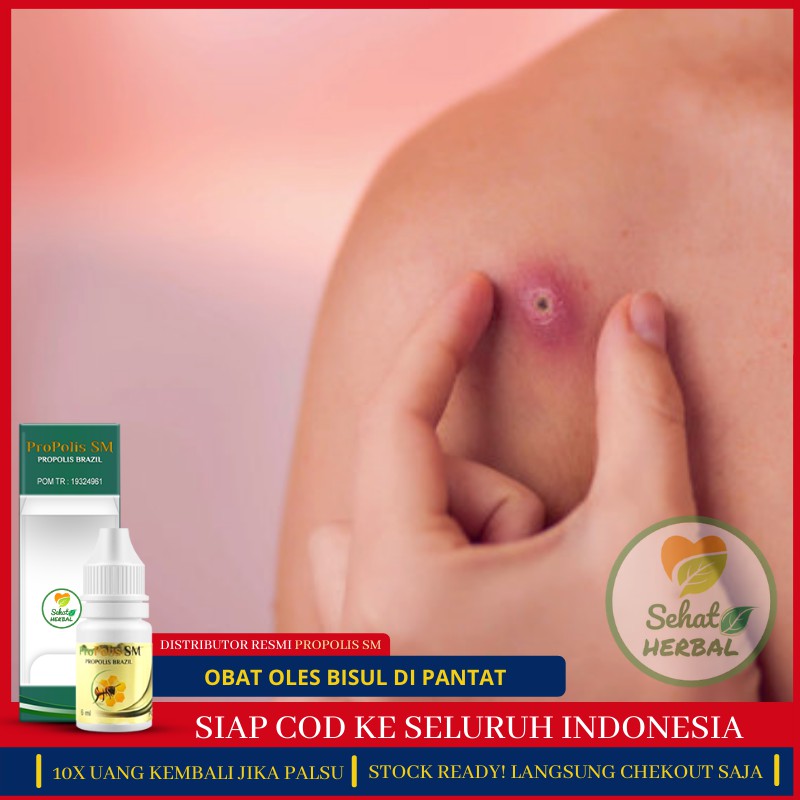 Furunkel/bisul berkembang dengan cepat berbentuk benjolan merah mudah atau merah. Obat Herbal Bisul Tanpa Mata Bisul Di Pantat Bisul Bernanah Bisul Di Kelamin Propolis Sm Asli Shopee Indonesia