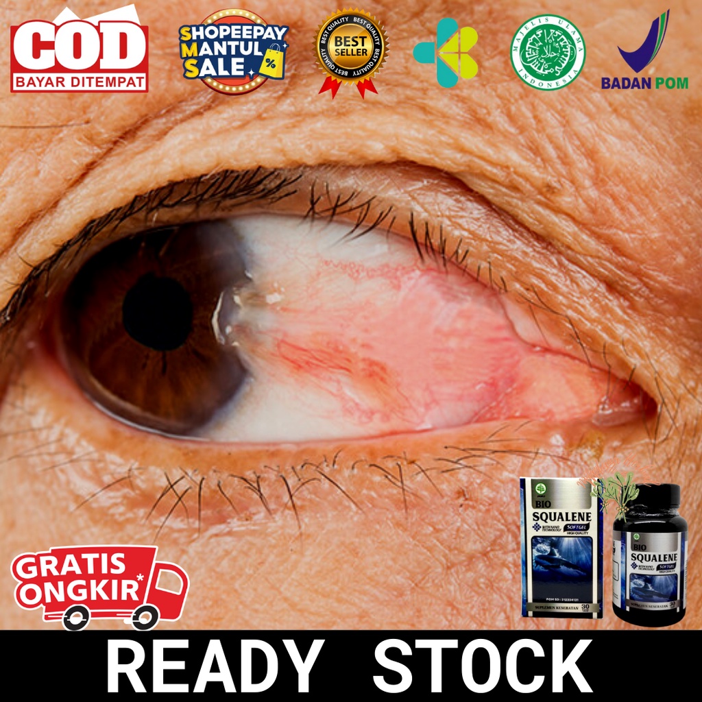 Obat Mata Pterigium, Obat Herbal Mata Pterigium, Obat Mata Pterygium, Obat  Mata Berlemak, Obat Mata Berlendir, Obat Lemak Di Mata, Menghilangkan Mata  Berlemak, Obat Mata Berlemak Ptergyum, Mata Merah Berlemak - Bio
