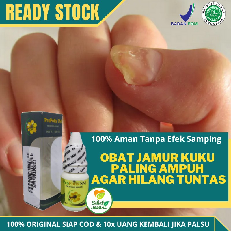 Kuku rusak dan kuning akibat jamur? Obat Jamur Kuku Obat Jamur Kuku Kaki Obat Jamur Kuku Alami Obat Jamur Kuku Bau Propolis Sm Shopee Indonesia