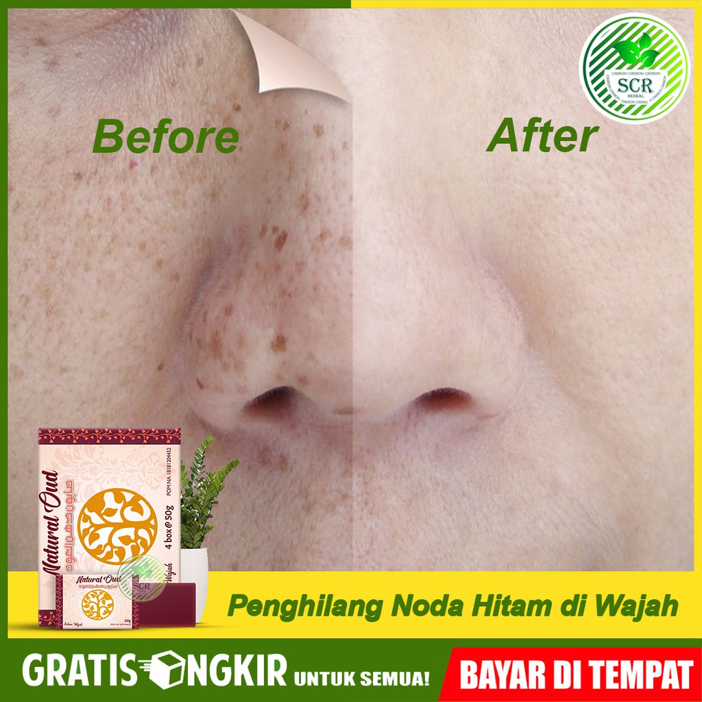 Untuk melawan masalah jerawat di kulit wajah, bisa dilakukan dengan sangat mudah, men. Sabun Herbal Penghilang Flek Noda Bintik Hitam Di Wajah Pria Wanita Natural Oud Free Ongkir Shopee Indonesia