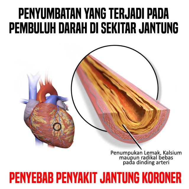 Obat Jantung Koroner Dan Stroke Iskemik Melarutkan Plak