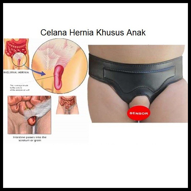 Hernia umbilikalis adalah kondisi saat bagian usus menonjol keluar dari pusar. Celana Hernia Anak Bayi Balita Usia 1 8 Tahun Pengobatan Hernia Pada Anak Ampuh Terpercaya Shopee Indonesia