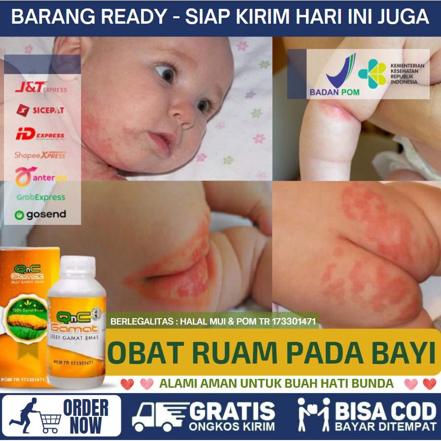 Biasanya terjadi pada bagian leher, wajah, punggung, dan juga bagian bokong pada bayi yang terkena popok. Obat Oles Ruam Merah Pada Selangkangan Bayi Akibat Iritasi Popok Qnc Jelly Gamat 100 Asli Alami Shopee Indonesia