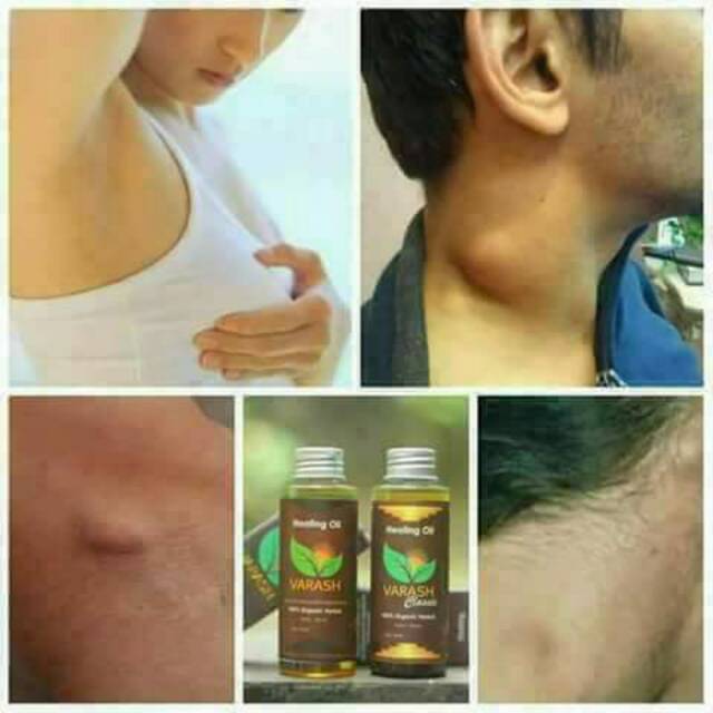 Varash Classic Utk Benjolan Payudara Belakang Telinga Leher