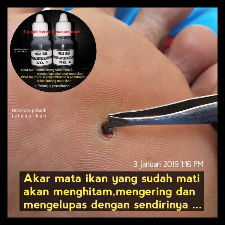 Bahan lain yang bisa anda manfaatkan untuk mengatasi mata ikan adalah losion pelembab atau krim yang terbuat dari asam salisilat. Obat Penyakit Mata Ikan Atau Clavus Bukan Plester Salep Callusol Shopee Indonesia