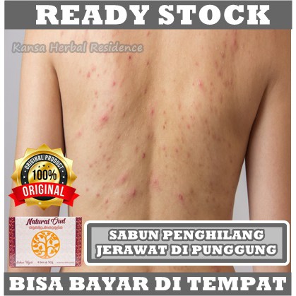 Cara menghilangkan jerawat secara alami · 1. Harga Obat Jerawat Punggung Dan Dada Terbaru November 2021 Biggo Indonesia