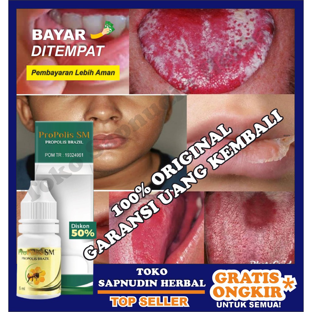 Cara mengobati sariawan di lidah · 1. Obat Herbal Untuk Bercak Putih Di Lidah Lidah Sariawan Benjolan Di Lidah Lidah Peta Alami Shopee Indonesia