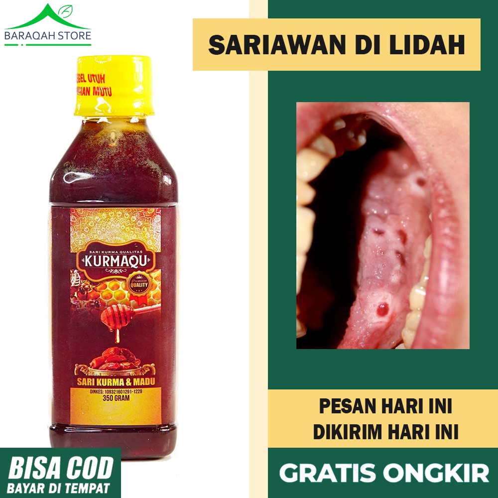 Hal itu karena enzim bromelain penyebab lidah gatal terdapat di seluruh bagian buah nanas, namun paling banyak ditemukan di bagian tengah buah . Harga Obat Sariawan Lidah Terbaru November 2021 Biggo Indonesia