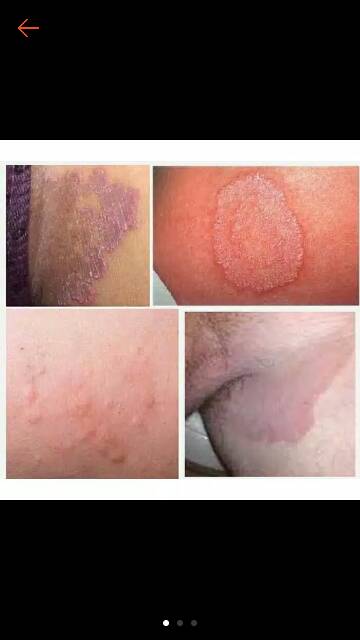 terbukti paling ampuh Obat gatal panu jamur kudis eksim jerawat cepat aman  anak dewasa | Shopee Indonesia