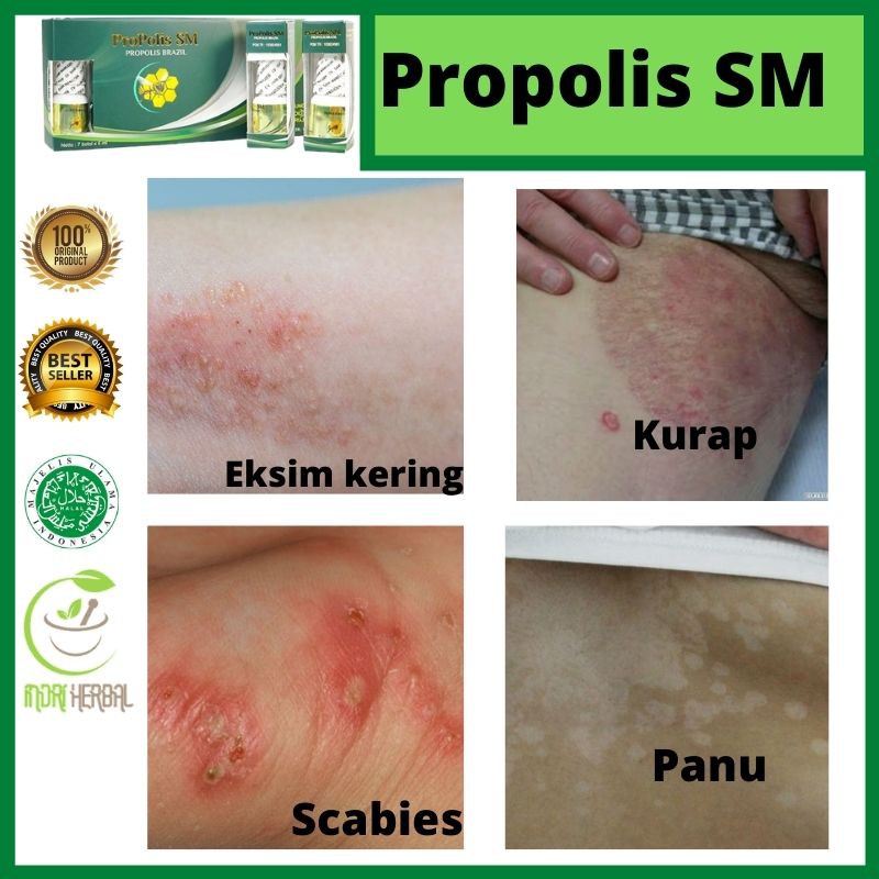 Eczema herpeticum usually appears on the face and neck. Propolis Sm Obat Tetes Minum Obat Penyakit Kurap Kudis Scabies Buduk Eksim Penyakit Kulit Bpom Shopee Indonesia