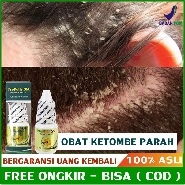 29/3/2022 · lakukan perawatan rambut rontok dan ketombe ini tepat sebelum mandi setiap hari untuk hasil terbaik. Jual Obat Ketombe Rambut Rontok Ketombe Kering Basah Berkerak Gatal Kulit Kepala Propolis Sm Indonesia Shopee Indonesia