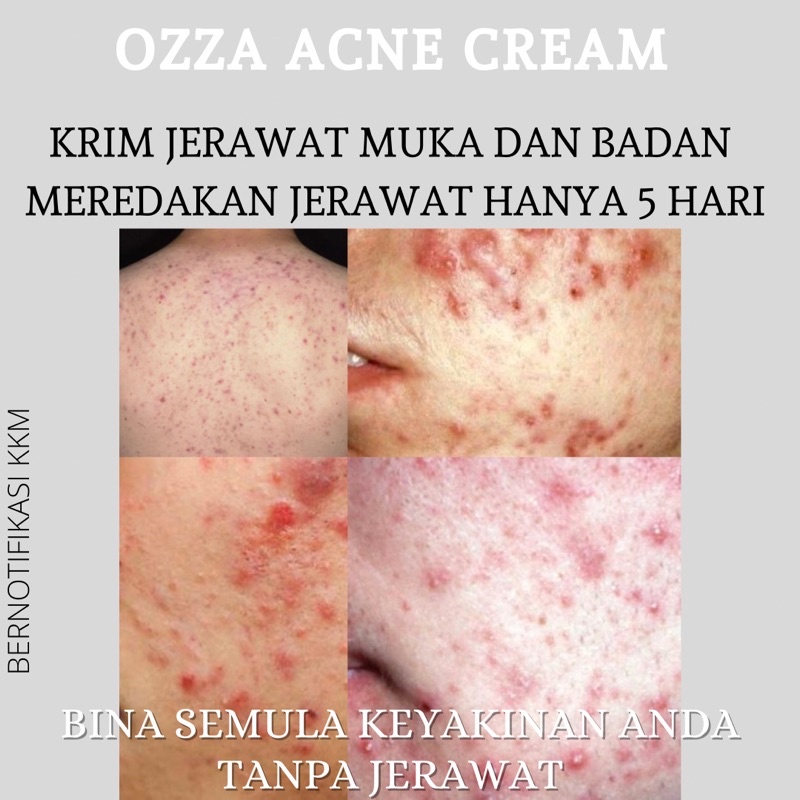 Jerawat di badan yang selalunya menjadi masalah kerana jerawat tumbuh di. Buy Krim Jerawat Pasir Jerawat Batu Jerawat Bernanah Atasi Masalah Hanya 3 Hari Dengan Ozza Tretment Cream Seetracker Malaysia