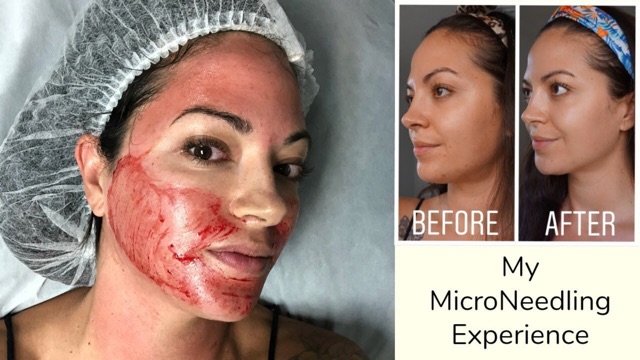 Since microneedling is considered a cosmetic or aesthetic. 12 Pin Microneedling Dermapen Needles Grater Shopee Singapore