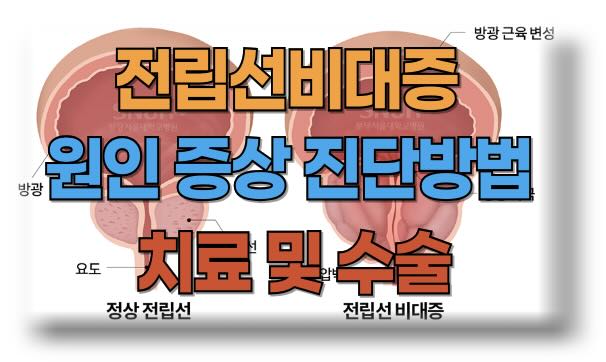 전립선비대증 원인, 증상, 진단방법 및 치료 방법과 수술비용