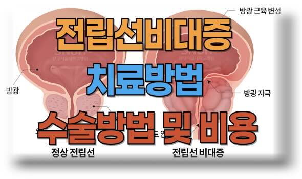 전립선비대증 치료 방법, 수술 방법 및 비용 정보