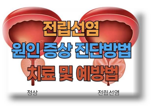 전립선염의 증상, 원인, 진단, 치료법