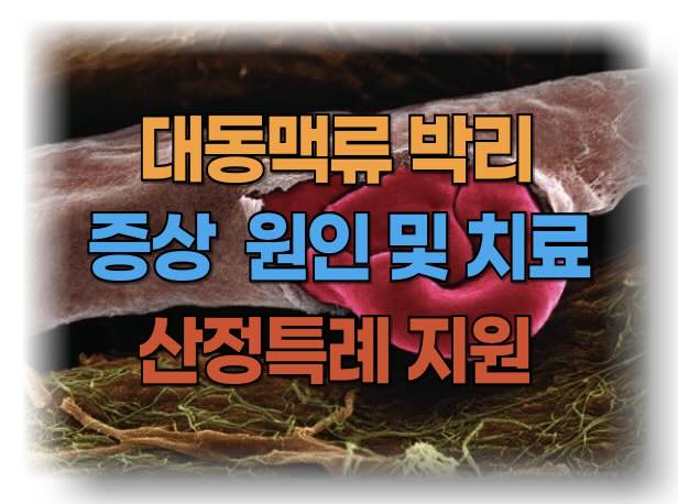 대동맥류와 대동맥 박리의 증상, 원인, 치료 방법, 그리고 경제적 부담을 줄여주는 산정특례 제도