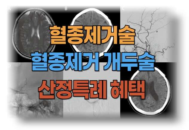 뇌출혈 혈종제거술과 혈종 제거방법