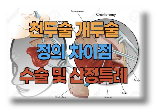 천두술, 개두술, 두개절제술