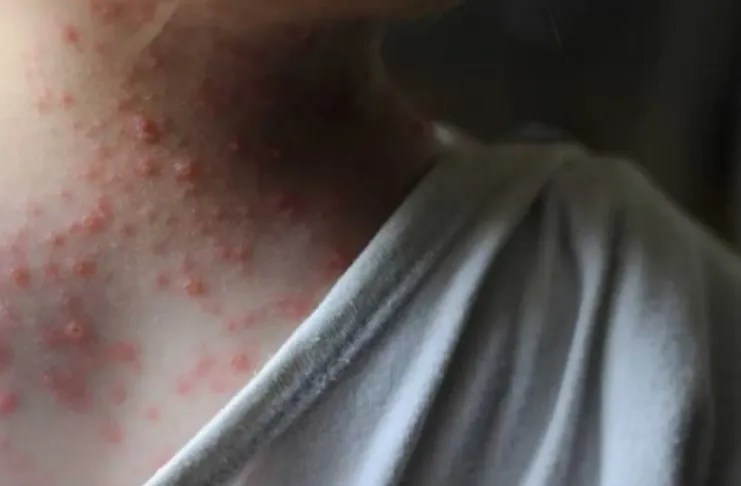 Viruela del mono aumenta sus casos en Argentina, la mayoría son «autóctonos»