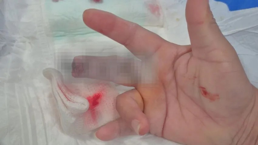 Un paciente bajo efectos de drogas atacó a una enfermera y le arrancó un dedo de un mordisco