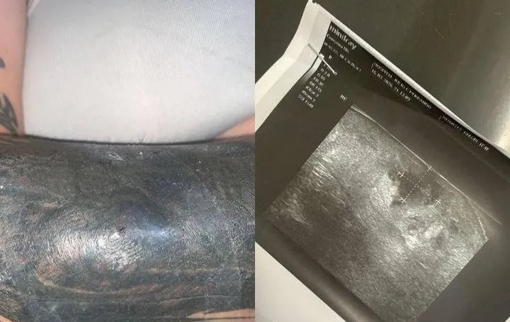 Docente trans denunció mala praxis y un brutal ataque transfóbico tras un tatuaje infectado