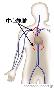 抗癌剤を静脈投与する末梢静脈と刺激性の抗癌剤でも影響が少ない中心静脈(鎖骨下静脈,内頚静脈,大腿静脈)