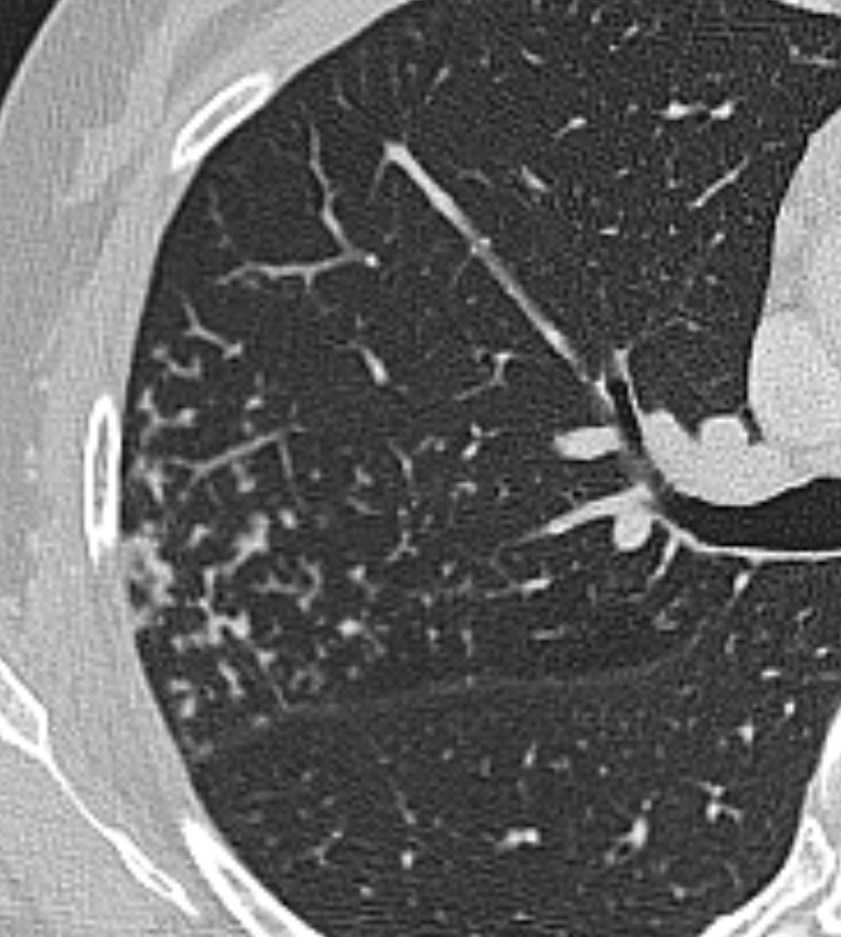 Tree In Bud Sign Lung Radiology Reference Article Radiopaedia Org