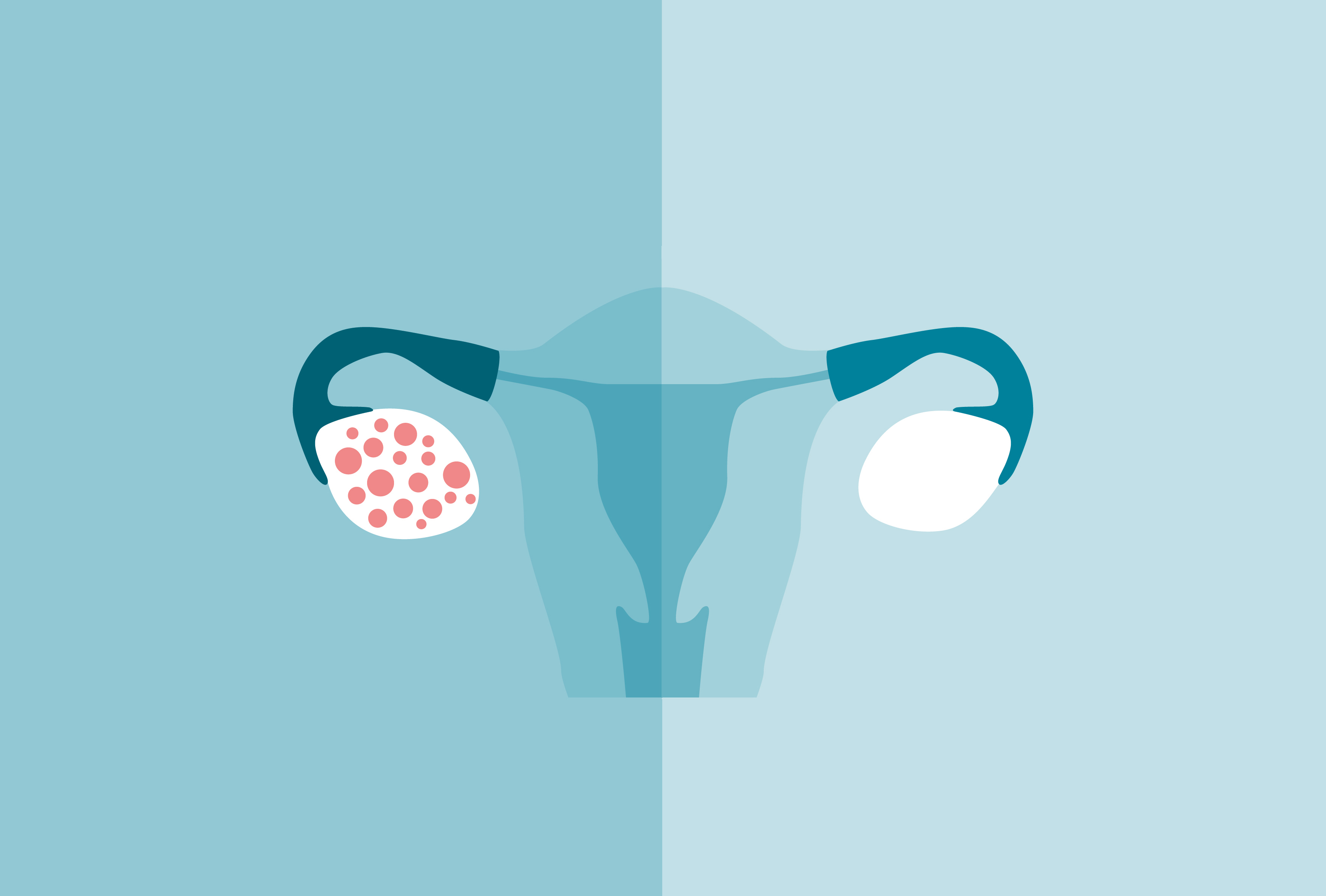 BUỒNG TRỨNG ĐA NANG (PCOS) NÊN BỔ SUNG VITAMIN GÌ THÌ TỐT?