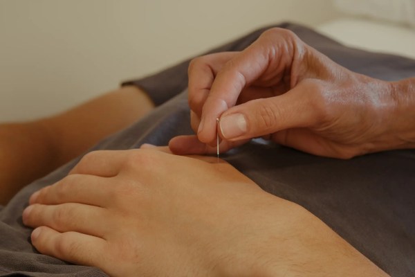 person receiving acupuncture