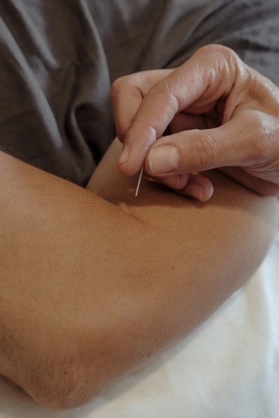man receiving acupuncture