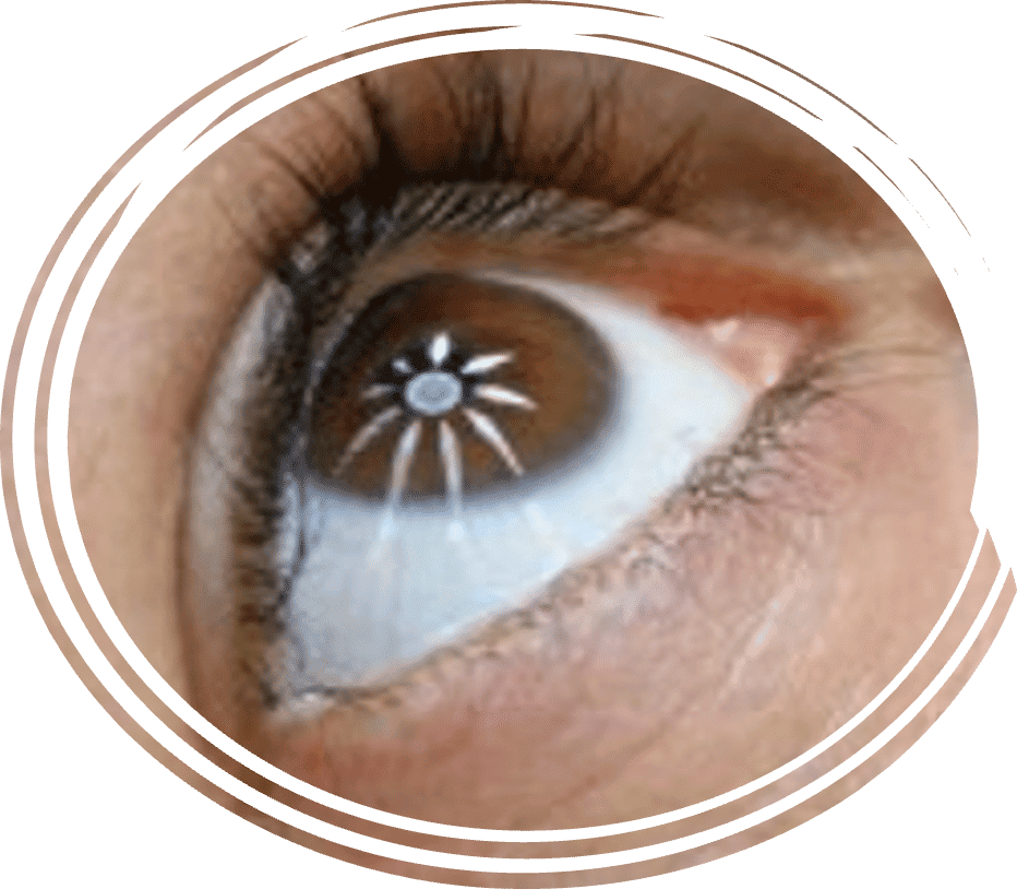 Clear eye with ChitoLytic: Innovative eye health treatment for better vision and comfort.