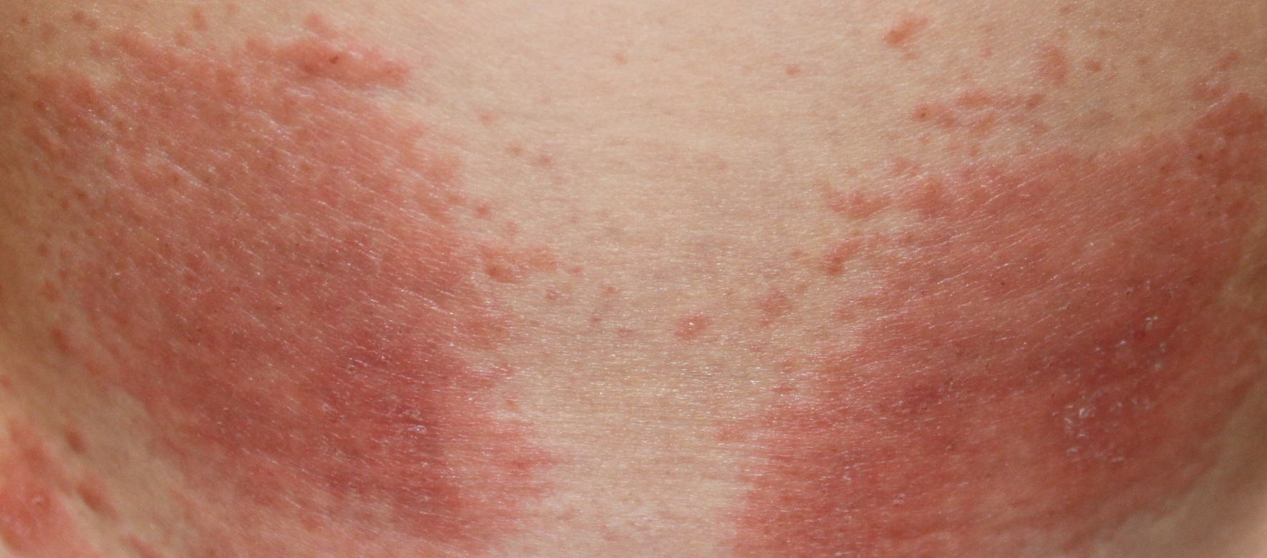 skin rash