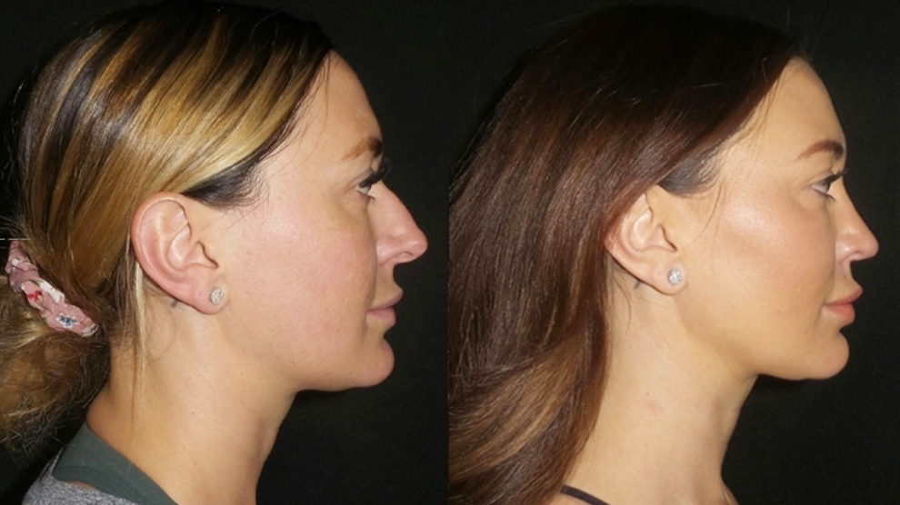 Foto Before After.