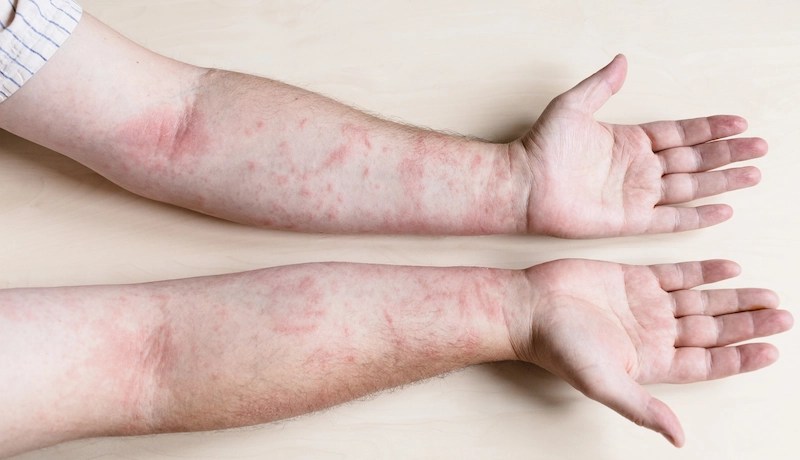 eczema