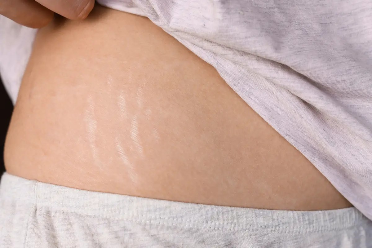stretch mark removal