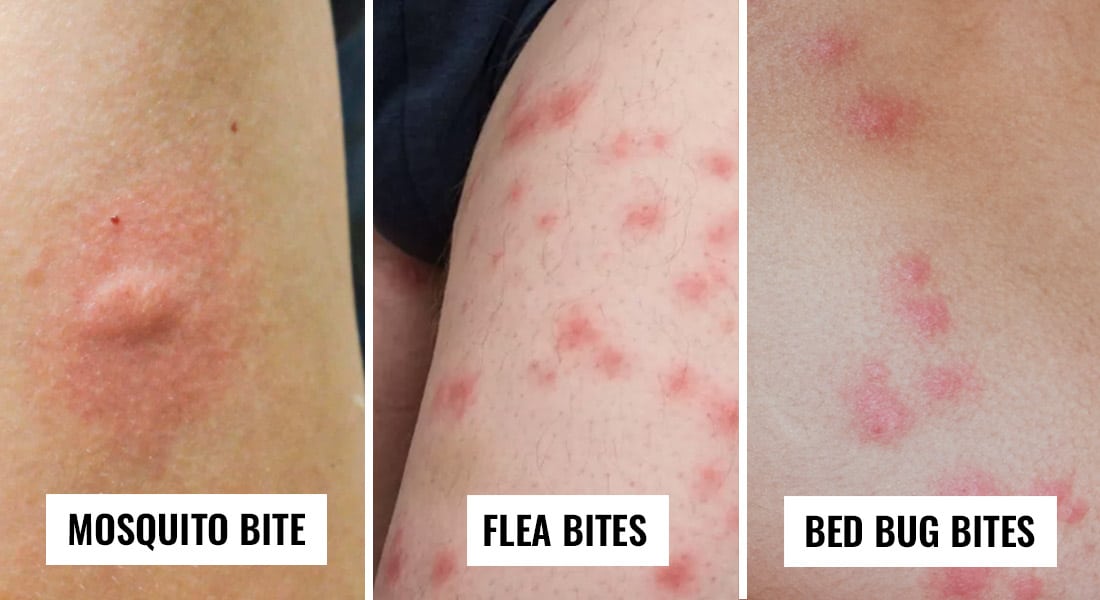 Bed bug bites