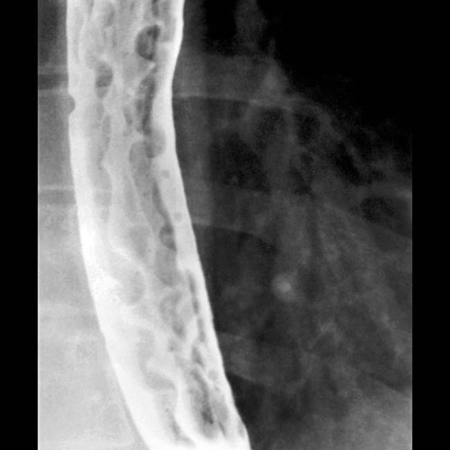 There are many courses available, so find out more here. Esophageal Varices Clinical Gate