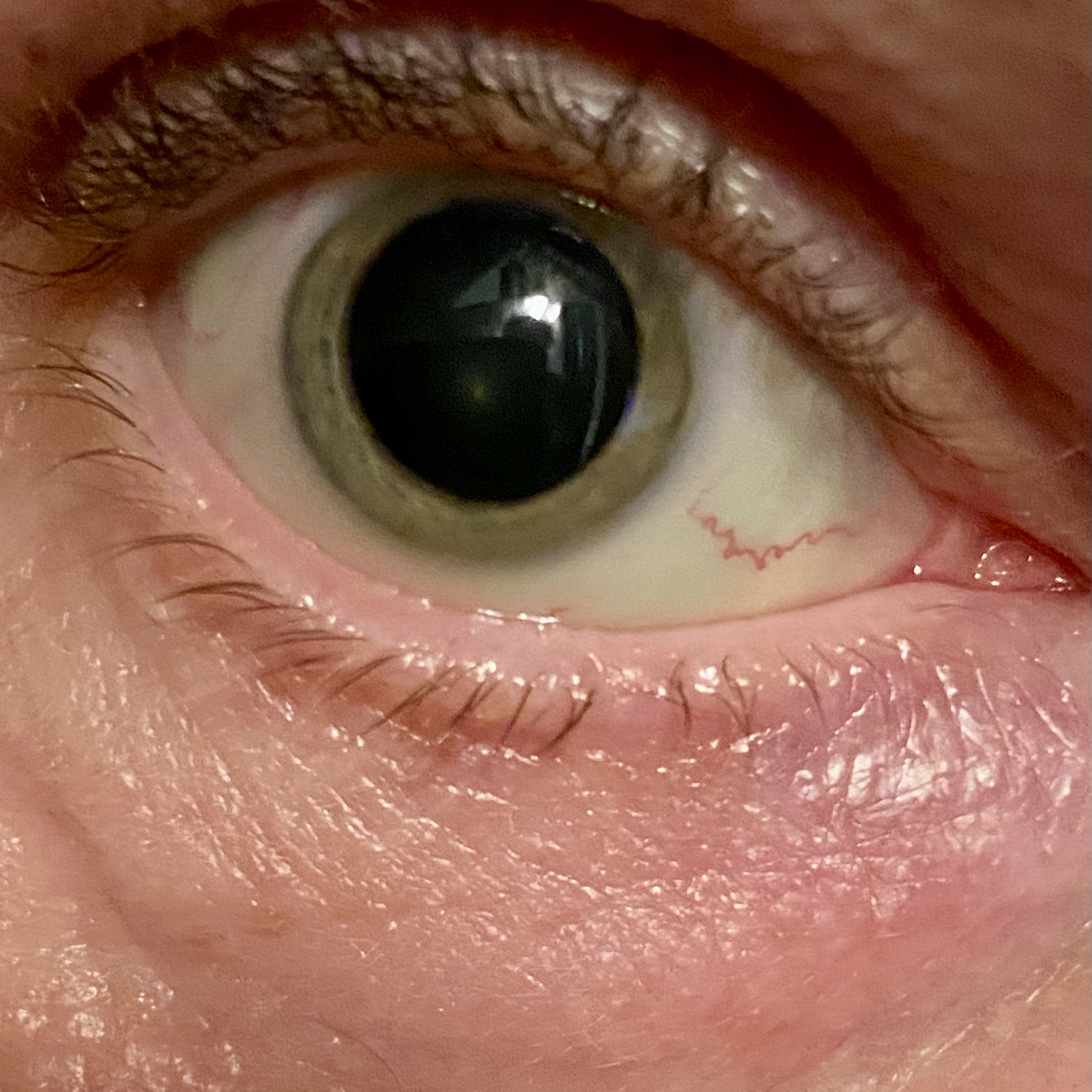 Pupille dilatée / Oeil (mydriase) - 2021/09/17