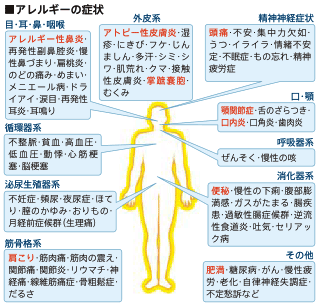 遅延型フードアレルギー検査で、「隠れアレルギー」の原因をつきとめる：コメット歯科の医療情報：岐阜市 インプラント・顎関節治療センター 岐阜