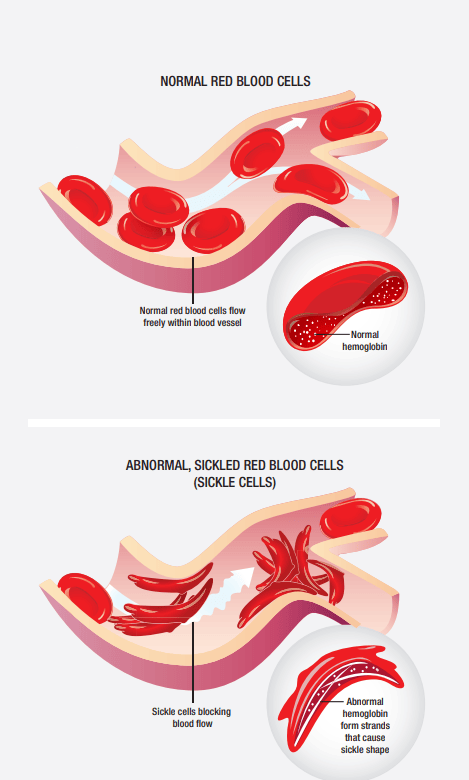 Awareness Campaign Launched for Sickle-cell disease (SCD) - Rau's IAS