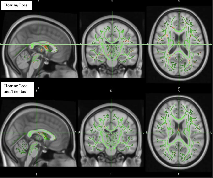 Read more about the article Neuroanatomical changes in gray and white matter due to tinnitus and hearing loss in a Military Population