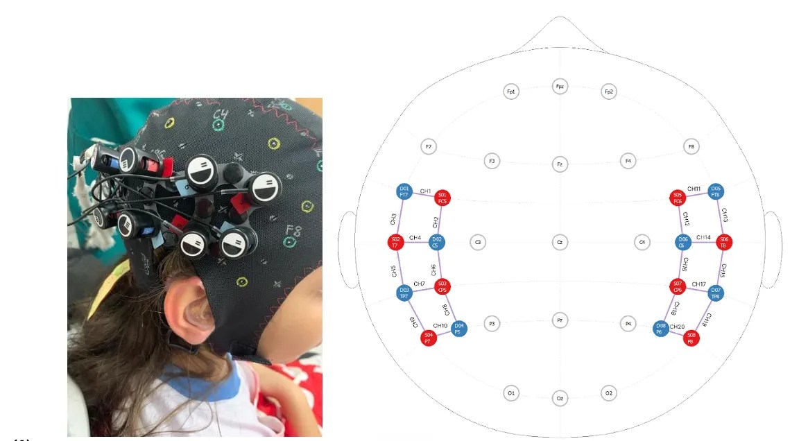 Read more about the article Mapping Cortical Hemodynamics via fNIRS in Bimodal Hearing Children: A Case Study on Optimizing Cortical Development during Transition to Bilateral Implants
